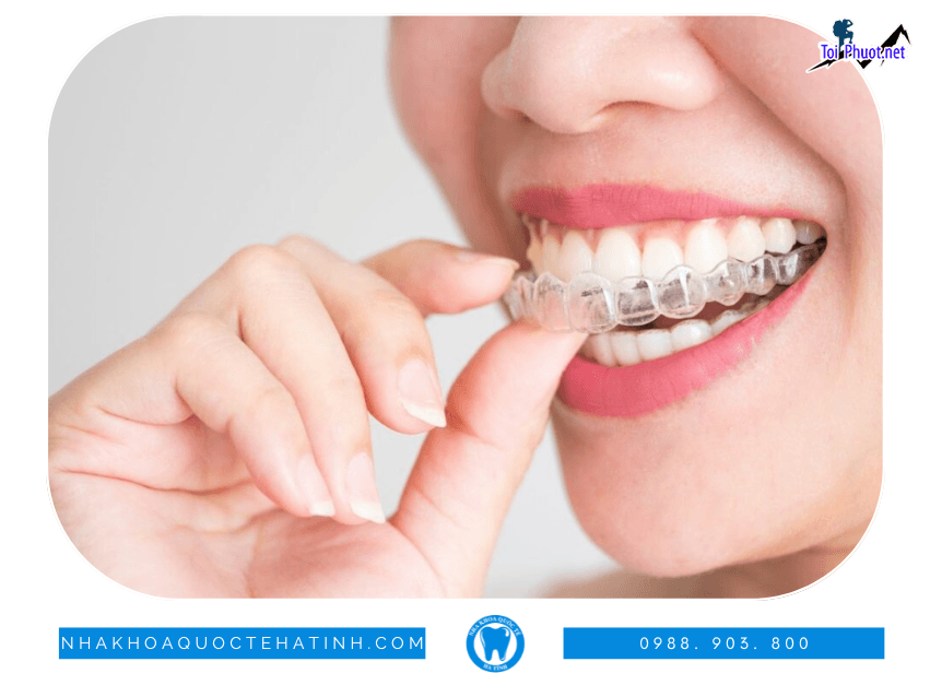 Top 6 địa chỉ niềng răng invisalign tại Lào Cai uy tín nhất cam kết các dịch vụ uy tín